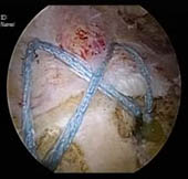 Arthroscopic Rotator Cuff Repair Using Double Row Technique