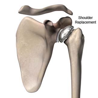 Total Shoulder Replacement Arthroplasty